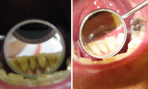 Dentální hygiena BRNO - Pískování zubů